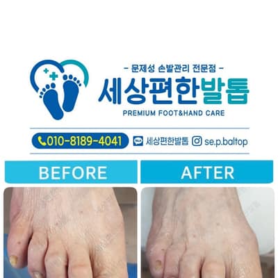 [전남 광양] 세상편한발톱 체험단