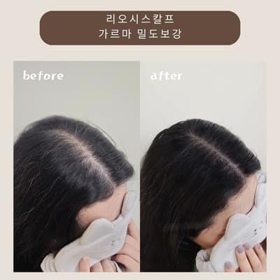[대구 달서구] 리오시스칼프 체험단